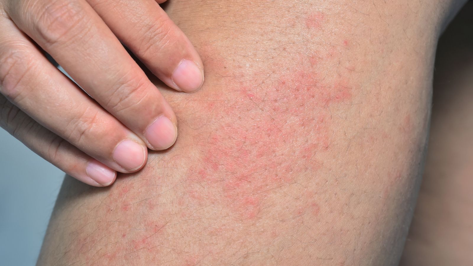 A close-up shot of a skin irritation